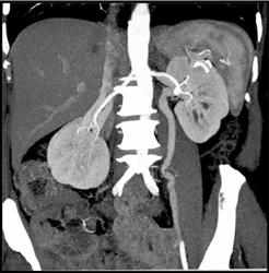 Prominent Left Gonadal Vein - CTisus CT Scan