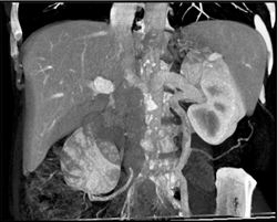 Prominent Left Gonadal Vein - CTisus CT Scan