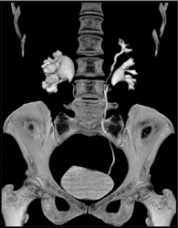 Duplicated Left Collecting System and Right Ureteropelvic Junction (UPJ) - CTisus CT Scan