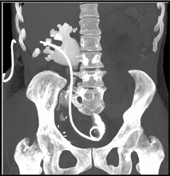 Stent in Right Ureteropelvic Junction (UPJ) - CTisus CT Scan