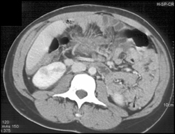 Acute Pyelonephritis - CTisus CT Scan