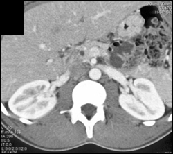 Clot in Right Renal Vein - CTisus CT Scan