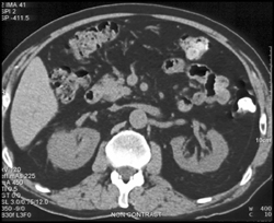 Right Renal Cell Carcinoma Was A Hemangiopericytoma - CTisus CT Scan