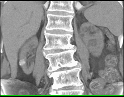 High Density Renal Cyst - CTisus CT Scan