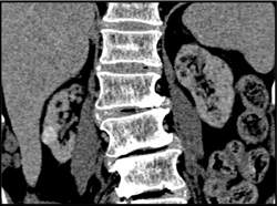 High Density Renal Cyst - CTisus CT Scan