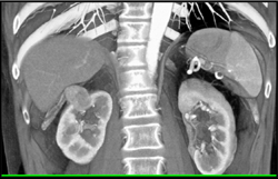 Hemangiopericytoma of the Kidney - CTisus CT Scan