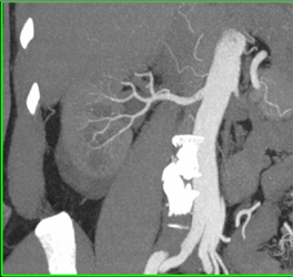 Normal CTA of the Kidney - CTisus CT Scan