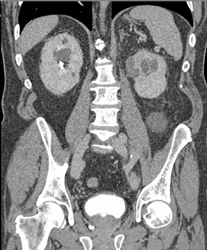 Cystic Renal Disease - CTisus CT Scan