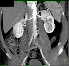 2 Right Renal Arteries and Prehilar Branching on the Left - CTisus CT Scan