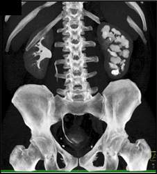 Dilated and Blunted Calyces in the Left Kidney With Loss of Cortex - CTisus CT Scan