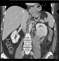 Spontaneous Bleed From Renal Cell Carcinoma - CTisus CT Scan