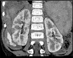 Multiple Small High Density Cysts - CTisus CT Scan