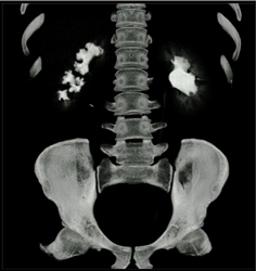 Blunted Calyces - CTisus CT Scan