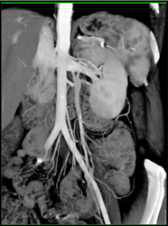 Prominent Gonadal Vein - CTisus CT Scan