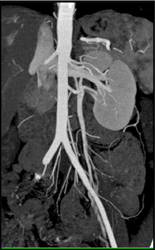 Images of Renal Vein in MIP and VRT. Check Location of Vein - CTisus CT Scan