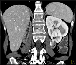 Scarred Lower Pole of Crossed Renal Ectopia - CTisus CT Scan