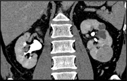 Renal Cell Carcinoma - CTisus CT Scan