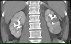 Calyceal Diverticulum - CTisus CT Scan