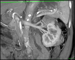 Renal Cell Carcinoma - CTisus CT Scan