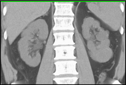 Renal Cell Carcinoma - CTisus CT Scan