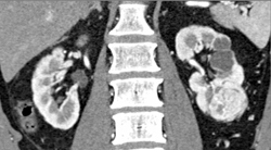 Renal Cell Carcinoma - CTisus CT Scan