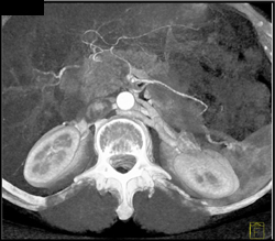 Retroaortic Renal Vein - CTisus CT Scan