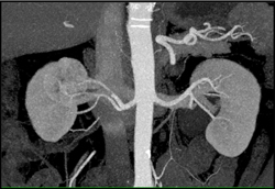 Prehilar Branching on Right as Well as Renal Cell Carcinoma (RCC) - CTisus CT Scan