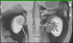 Renal Cell Carcinoma - CTisus CT Scan