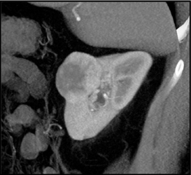 Renal Cell Carcinoma - CTisus CT Scan