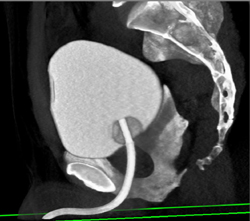 Ct Cystogram Is Normal - CTisus CT Scan