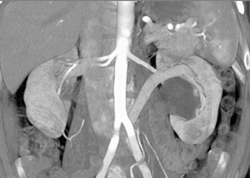 Retroaortic Renal Vein - CTisus CT Scan