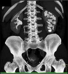 Blunted and Deformed Calyces - CTisus CT Scan