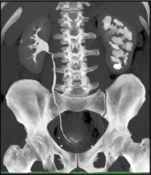 Filling Defects in Calyces - CTisus CT Scan