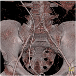 Retroperitoneal Fibrosis Encases the Right Iliac Artery - CTisus CT Scan