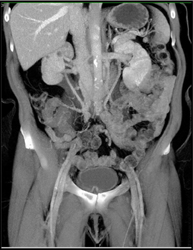 Retroperitoneal Fibrosis - CTisus CT Scan