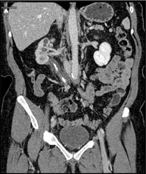 Retroperitoneal Fibrosis - CTisus CT Scan