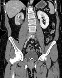 Retroperitoneal Fibrosis - CTisus CT Scan