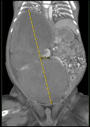 Wilms Tumor - CTisus CT Scan