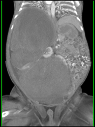 Wilms Tumor - CTisus CT Scan