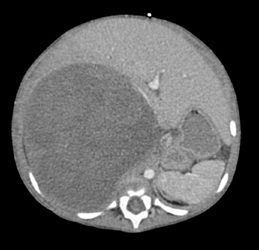 Wilms Tumor - CTisus CT Scan