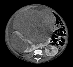 Wilms Tumor - CTisus CT Scan