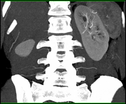 Subtle Vascular Renal Cell Carcinoma (RCC) on the Left - CTisus CT Scan