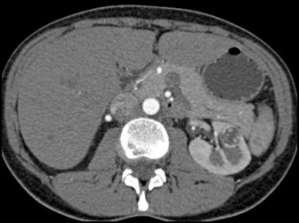 Subtle Renal Cell Carcinoma (RCC) - CTisus CT Scan