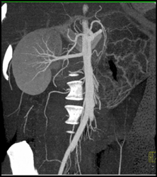 Normal Right Kidney in MIP and VRT - CTisus CT Scan