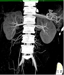 Normal CTA MIP Vs VRT - CTisus CT Scan