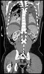 Renal Infarction - CTisus CT Scan