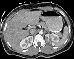 Renal Infarction - CTisus CT Scan