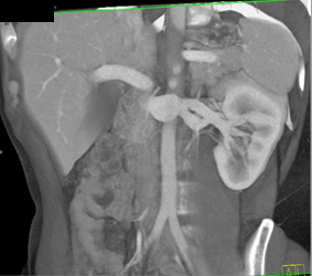 Bifid Renal Vein - CTisus CT Scan