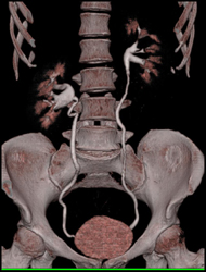 Ct Urogram - CTisus CT Scan