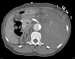 Spontaneous Bleed in Left Kidney- End Stage Renal Disease (ESRD) - CTisus CT Scan